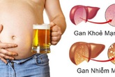 Dấu hiệu người bị gan nhiễm mỡ phải cảnh giác, đặc biệt là sau Tết Dấu hiệu người bị gan nhiễm mỡ phải cảnh giác, đặc biệt là sau Tết