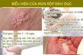 Mụn rộp sinh dục Mụn rộp sinh dục