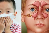 Có thể điều trị viêm xoang bằng cây lá? Có thể điều trị viêm xoang bằng cây lá?