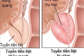 Những phương thuốc từ cỏ nhọ nồi Những phương thuốc từ cỏ nhọ nồi