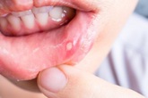 Nhiệt miệng, vì sao? Nhiệt miệng, vì sao?