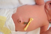 Những bất thường ở rốn trẻ sơ sinh cảnh báo bệnh nguy hiểm, cha mẹ cần phải biết Những bất thường ở rốn trẻ sơ sinh cảnh báo bệnh nguy hiểm, cha mẹ cần phải biết