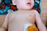 Xót xa bé trai hơn tuổi dị tật bàng quang ngoài bẩm sinh, không có hậu môn Xót xa bé trai hơn tuổi dị tật bàng quang ngoài bẩm sinh, không có hậu môn