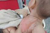 Bé 2 tuổi bị bỏng nước sôi pha mì tôm khi đùa cùng anh trai Bé 2 tuổi bị bỏng nước sôi pha mì tôm khi đùa cùng anh trai