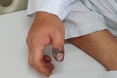 Mới vào hè, liên tiếp bệnh nhân bị rắn độc cắn, bác sĩ chỉ ra sai lầm "biết rồi nói mãi" Mới vào hè, liên tiếp bệnh nhân bị rắn độc cắn, bác sĩ chỉ ra sai lầm "biết rồi nói mãi"