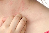 Kỳ lạ cách chữa dị ứng thời tiết đơn giản hiệu quả bằng cỏ dại nhưng rất ít người biết Kỳ lạ cách chữa dị ứng thời tiết đơn giản hiệu quả bằng cỏ dại nhưng rất ít người biết