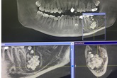 Bác sĩ gắp răng lúc nhúc trong miệng nam thanh niên Hà Nội Bác sĩ gắp răng lúc nhúc trong miệng nam thanh niên Hà Nội