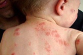 Mẹ bầu chủ quan có thể khiến con mắc bệnh hiếm gặp từ trong bụng mẹ Mẹ bầu chủ quan có thể khiến con mắc bệnh hiếm gặp từ trong bụng mẹ