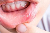 Viêm loét khoang miệng, nhiệt lưỡi, nhiệt miệng, nhiệt lợi, nhiệt miệng áp tơ đau xót không ăn uống được: dùng ngay gel bôi thảo dược Gumimouth Viêm loét khoang miệng, nhiệt lưỡi, nhiệt miệng, nhiệt lợi, nhiệt miệng áp tơ đau xót không ăn uống được: dùng ngay gel bôi thảo dược Gumimouth