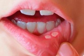 Viêm loét khoang miệng, nhiệt miệng, nhiệt lưỡi, nhiệt lợi chữa mãi không khỏi - xem ngay nguyên nhân và biện pháp khắc phục hiệu quả Viêm loét khoang miệng, nhiệt miệng, nhiệt lưỡi, nhiệt lợi chữa mãi không khỏi - xem ngay nguyên nhân và biện pháp khắc phục hiệu quả
