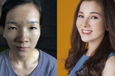 Cô gái bị bạn trai bỏ vì 'mắt lươn' kết hôn sau 3 năm dao kéo mặt Cô gái bị bạn trai bỏ vì 'mắt lươn' kết hôn sau 3 năm dao kéo mặt