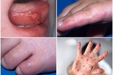 Cảnh báo gia tăng trẻ nhập viện do bệnh tay chân miệng, có thể thành ổ dịch lớn Cảnh báo gia tăng trẻ nhập viện do bệnh tay chân miệng, có thể thành ổ dịch lớn