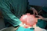 Khối u gần 9 kg trong bụng bà lão Khối u gần 9 kg trong bụng bà lão