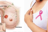 6 dấu hiệu cảnh báo sớm ung thư vú, chị em cần theo dõi thường xuyên hơn 6 dấu hiệu cảnh báo sớm ung thư vú, chị em cần theo dõi thường xuyên hơn