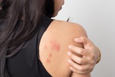 Những vết mẩn đỏ cảnh báo căn bệnh ung thư phổ biến Những vết mẩn đỏ cảnh báo căn bệnh ung thư phổ biến