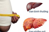 Dấu hiệu gan nhiễm mỡ có quá nguy hiểm? Dấu hiệu gan nhiễm mỡ có quá nguy hiểm?