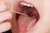 Ung thư lưỡi có thể phát hiện sớm? Ung thư lưỡi có thể phát hiện sớm?