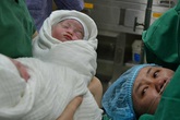 Sinh đôi sau 6 lần phẫu thuật Sinh đôi sau 6 lần phẫu thuật