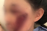 Áo chống nắng cuốn vào bánh xe khiến nữ sinh tổn thương mặt nghiêm trọng Áo chống nắng cuốn vào bánh xe khiến nữ sinh tổn thương mặt nghiêm trọng