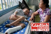 Nỗi đau tận cùng đeo đẳng chàng trai rụng dần tứ chi vì căn bệnh lạ triệu người mắc một Nỗi đau tận cùng đeo đẳng chàng trai rụng dần tứ chi vì căn bệnh lạ triệu người mắc một