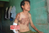 Người đàn ông 25 năm khốn khổ vì căn bệnh bỗng dưng mọc sẹo “khủng” đầy người Người đàn ông 25 năm khốn khổ vì căn bệnh bỗng dưng mọc sẹo “khủng” đầy người