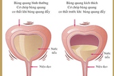 Viêm bàng quang – “cơn ác mộng” dẫn bạn đến nguy cơ vô sinh Viêm bàng quang – “cơn ác mộng” dẫn bạn đến nguy cơ vô sinh