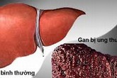 Hiểu tác nhân gây ung thư và xơ để có lá gan khỏe Hiểu tác nhân gây ung thư và xơ để có lá gan khỏe