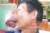 Lão nông nghèo 36 năm mang "khuôn mặt quỷ" Lão nông nghèo 36 năm mang "khuôn mặt quỷ"