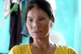 Người phụ nữ dị dạng vì đòn chồng Người phụ nữ dị dạng vì đòn chồng