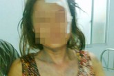 Phó ban Tuyên giáo huyện đánh một phụ nữ gẫy răng Phó ban Tuyên giáo huyện đánh một phụ nữ gẫy răng