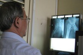 Mục hai khớp háng vì đắp thuốc “lang băm” Mục hai khớp háng vì đắp thuốc “lang băm”