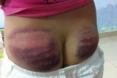 Kinh hoàng bé gái lớp 4 bị thầy giáo bạo hành tàn nhẫn Kinh hoàng bé gái lớp 4 bị thầy giáo bạo hành tàn nhẫn