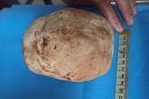 Kinh hãi viên sỏi nặng gần 1kg trong bàng quang Kinh hãi viên sỏi nặng gần 1kg trong bàng quang