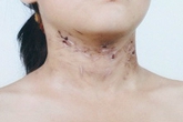 Nghi án bé gái bị bố và dì ghẻ đánh gãy xương sườn Nghi án bé gái bị bố và dì ghẻ đánh gãy xương sườn