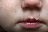 Chảy nước mũi, ho đờm xanh không cần dùng kháng sinh Chảy nước mũi, ho đờm xanh không cần dùng kháng sinh