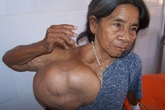 Phẫu thuật cho người có khối u khổng lồ Phẫu thuật cho người có khối u khổng lồ