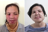 Trả lại gương mặt cho người phụ nữ bị bỏng axit Trả lại gương mặt cho người phụ nữ bị bỏng axit