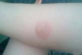 Kinh nghiệm dân gian sơ cứu bỏng Kinh nghiệm dân gian sơ cứu bỏng