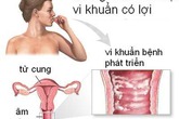 Những bệnh gây ra mùi khó chịu ở "vùng kín" Những bệnh gây ra mùi khó chịu ở "vùng kín"
