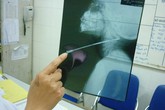 Bé 5 tuổi ngã bị kim đâm xuyên cổ Bé 5 tuổi ngã bị kim đâm xuyên cổ