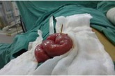 Kinh hãi bé 13 tuổi bị tăm tre đâm thủng ruột Kinh hãi bé 13 tuổi bị tăm tre đâm thủng ruột
