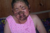 Người phụ nữ khốn khổ bởi vảy nến lở loét toàn thân Người phụ nữ khốn khổ bởi vảy nến lở loét toàn thân