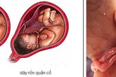 Những điều mẹ bầu nên biết về tràng hoa quấn cổ Những điều mẹ bầu nên biết về tràng hoa quấn cổ