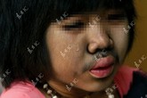 Đáng thương bé gái 9 tuổi bị mọc lông khắp cơ thể Đáng thương bé gái 9 tuổi bị mọc lông khắp cơ thể