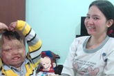 Hành trình tìm lại tuổi thơ của cậu bé bị cha đốt Hành trình tìm lại tuổi thơ của cậu bé bị cha đốt