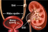Những điều bạn cần biết về bệnh sỏi thận Những điều bạn cần biết về bệnh sỏi thận