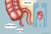 Nhận biết các triệu chứng của viêm ruột thừa Nhận biết các triệu chứng của viêm ruột thừa
