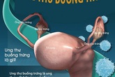 Ung thư buồng trứng – Kẻ giết người thầm lặng Ung thư buồng trứng – Kẻ giết người thầm lặng