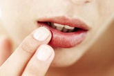 Giải quyết môi khô nứt nẻ bằng những cách đơn giản Giải quyết môi khô nứt nẻ bằng những cách đơn giản