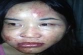 Cô giáo bị chồng hành hạ dã man Cô giáo bị chồng hành hạ dã man